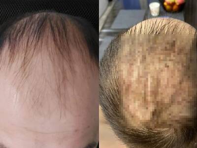 Жители Новосибирска получили кровавые залысины после операции по пересадке волос за 200 тысяч - bloknot.ru - Новосибирск