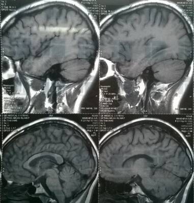 Неправильный иммунный ответ может быть причиной затяжных проблем с мозгом после COVID-19 - ufacitynews.ru - Сан-Франциско