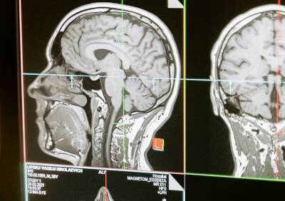Ученые выявили у умерших от COVID-19 изменения в мозге как при болезни Альцгеймера - ya62.ru - Колумбия - Covid-19