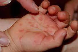 В США – вспышка энтеровируса, страдают взрослые и дети - golos.ua - Украина - Сша - штат Калифорния